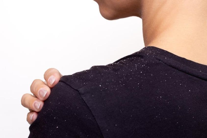 Joven mujer con camisa negra sosteniendo su hombro, rastros de caspa en la camisa.