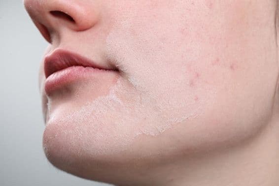 Mujer con piel seca en su rostro contra un fondo claro.