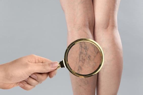 Mujer sufriendo de venas varicosas.